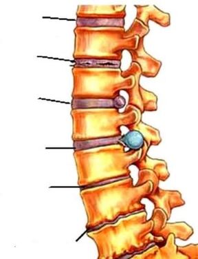 a gerinc osteocondritis fájdalom a hát bal oldalán az alsó hát felett